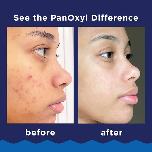 Which Acne Treatments ACTUALLY work?