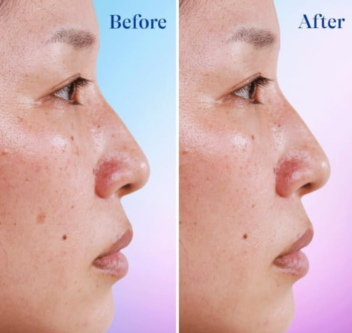 Differin Acne Dark Spot Correcting Face Serum