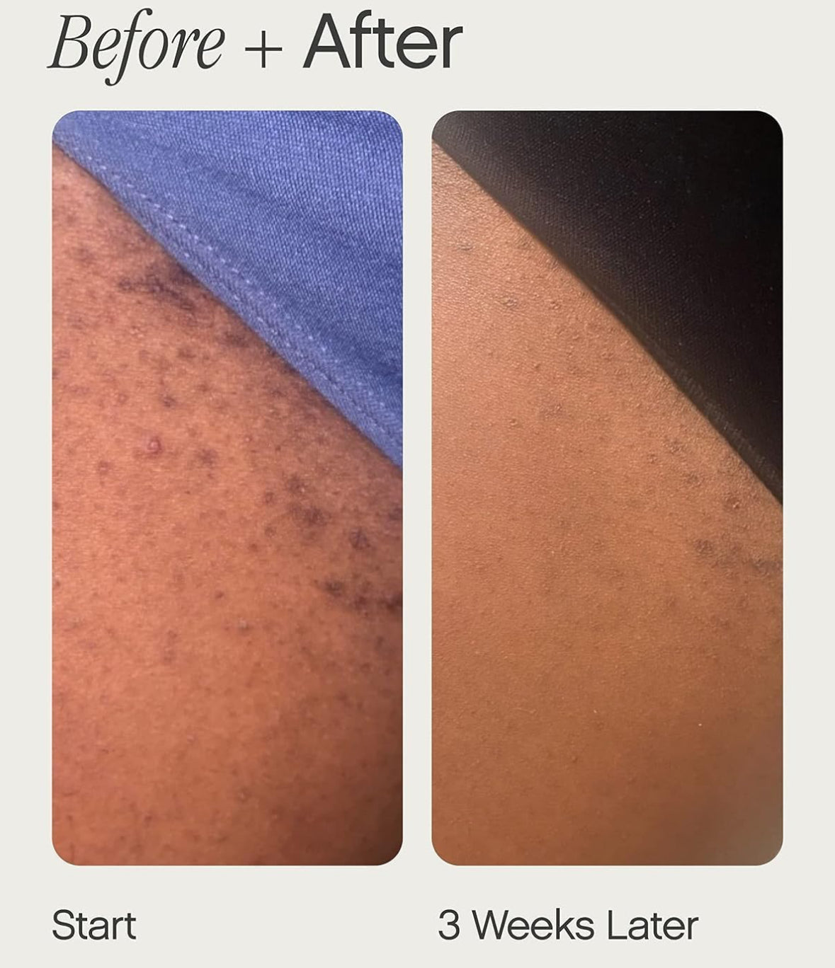 Topicals High Roller Ingrown Hair Serum