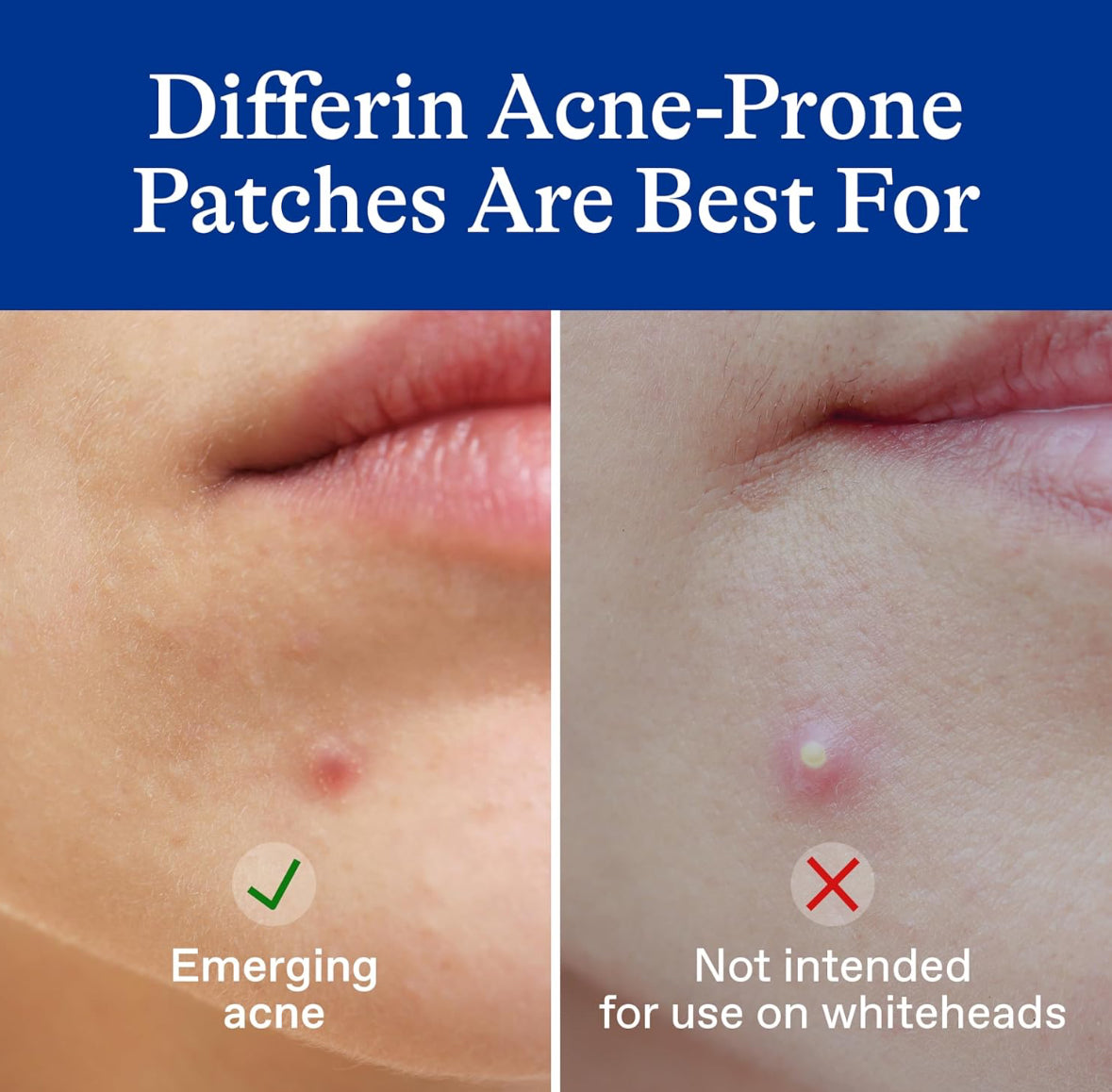 Differin Acne Pimple Patches 36 Count