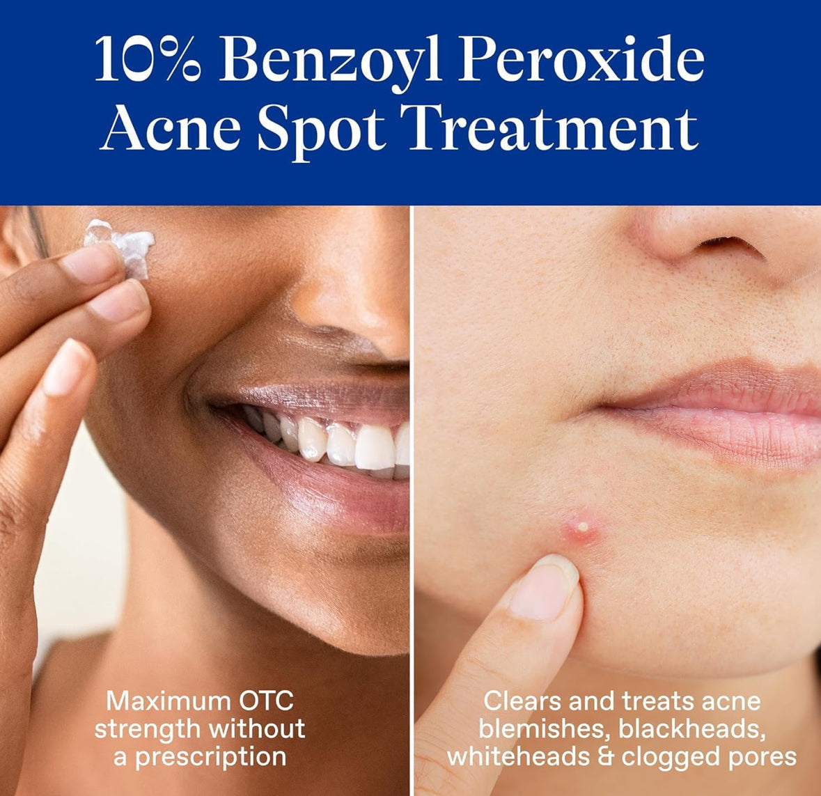 Differin Acne Spot Treatment with 10% Benzoyl Peroxide