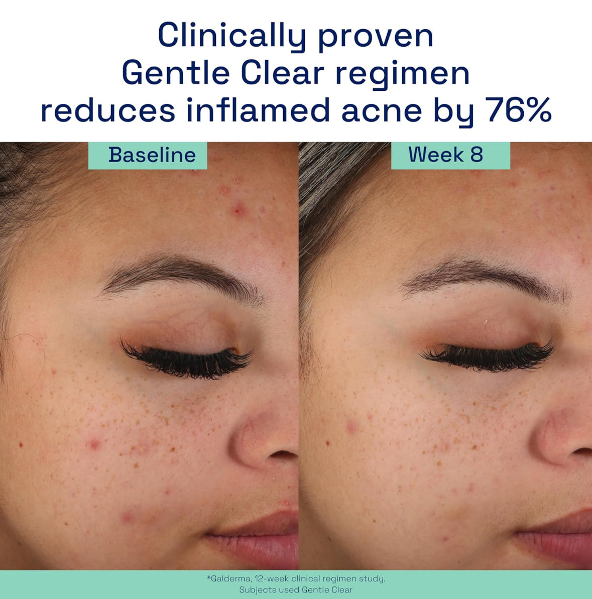 Cetaphil Acne Face Wash Cream Cleanser 2% Salicylic Acid