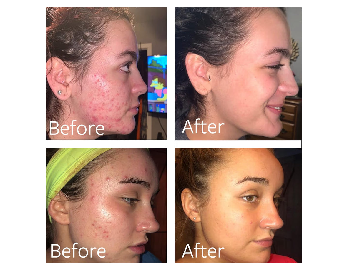Dr Song Benzoyl Peroxide Wash 10% with Hyaluronic Acid Acne Treatment