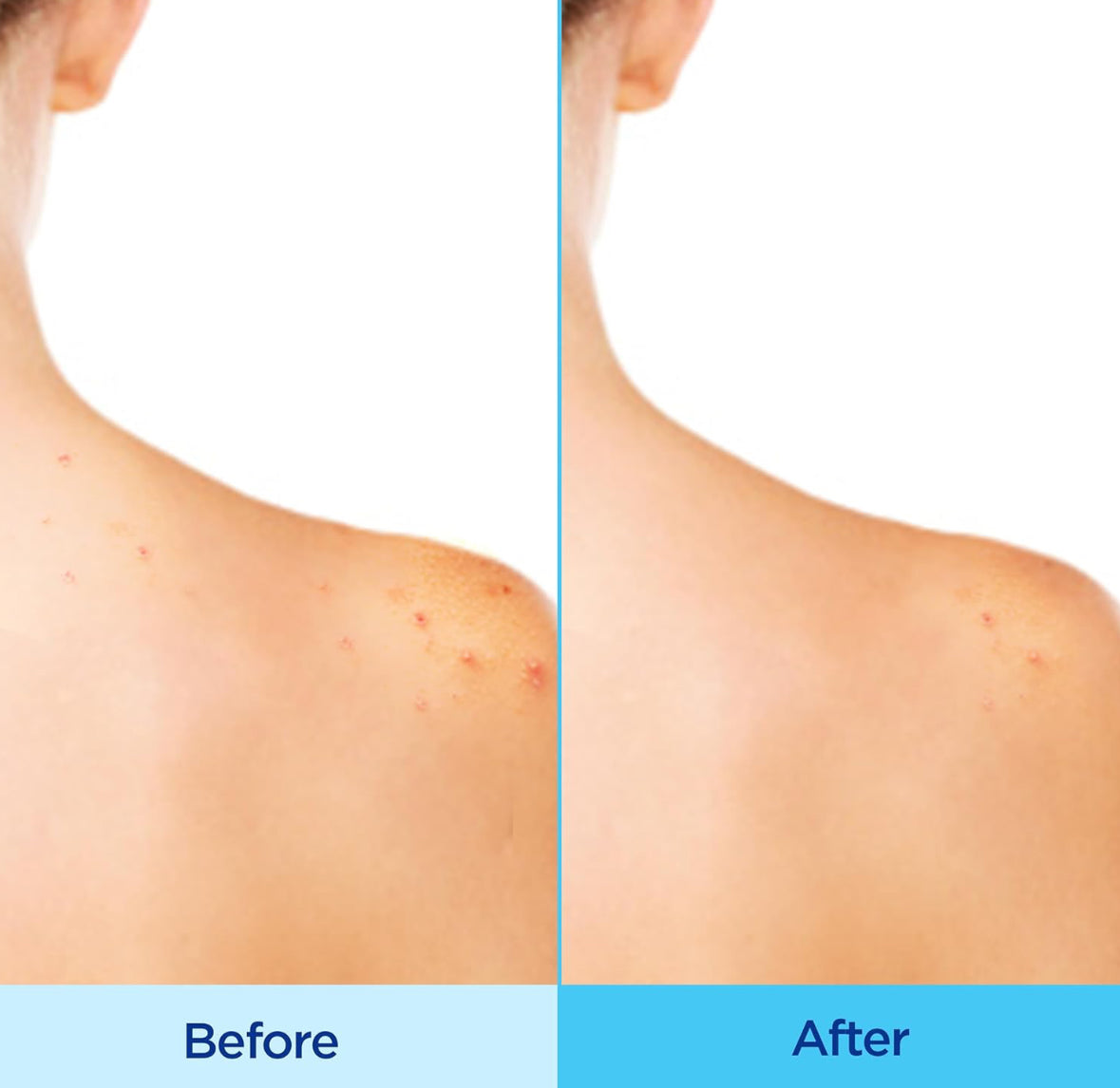 Differin Acne Body Spray with Salicylic Acid