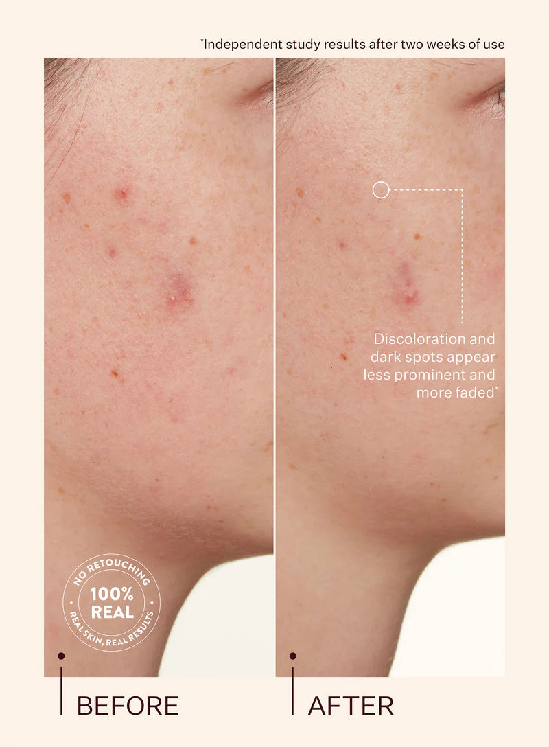 Peach & Lily Transparen-C Pro Spot Acne Treatment